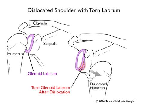 In addition, the ageing process may weaken the labrum leading to injury, such as a labrum sprain. Shoulder Injuries: Dislocated Shoulder and Labral Tear