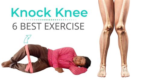 6 Best Knock Knee Correction Exercise In Hindi Youtube