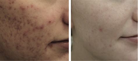 Laser Treatment For Acne And Acne Scars In Crest Hill And Naperville