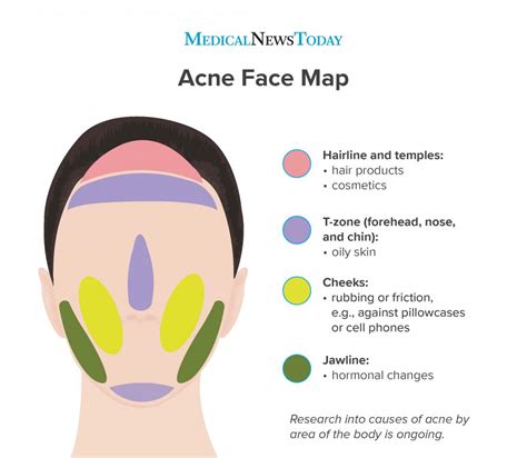 Acne Face Map Causes Of Breakouts 2023