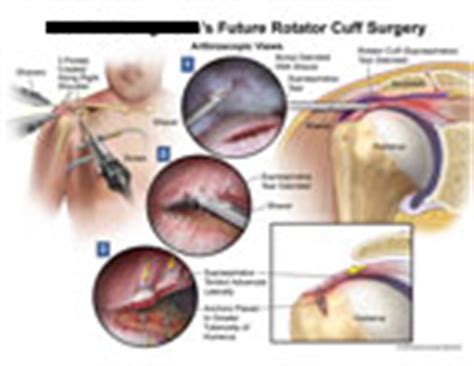 AMICUS Illustration Of Amicus Surgery Rotator Cuff Tear Bursa Debrided
