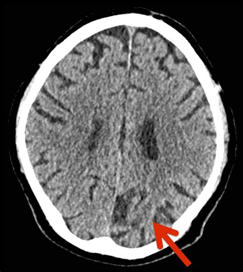 The Patients Ct Head Scan Arrow Denotes An Old Left Occipital Lobe