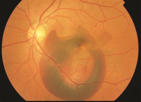 Polypoidal Choroidal Vasculopathy Retina Specialists Of North Alabama