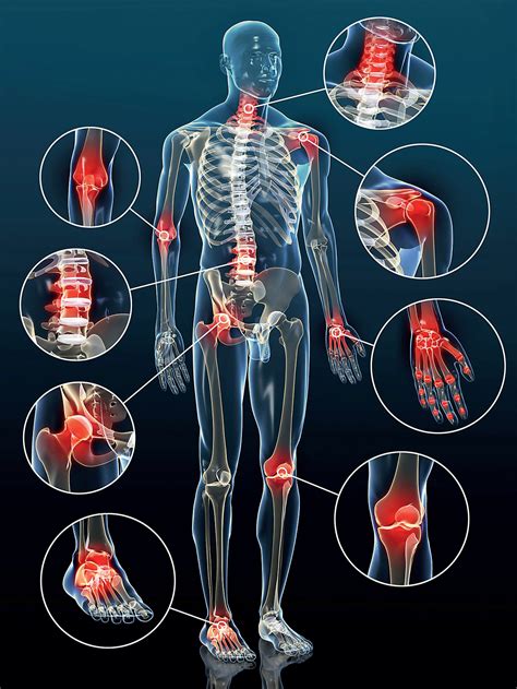 Rheuma Arthrose Arthritis Symptome Ursachen Von Gelenkschmerzen My