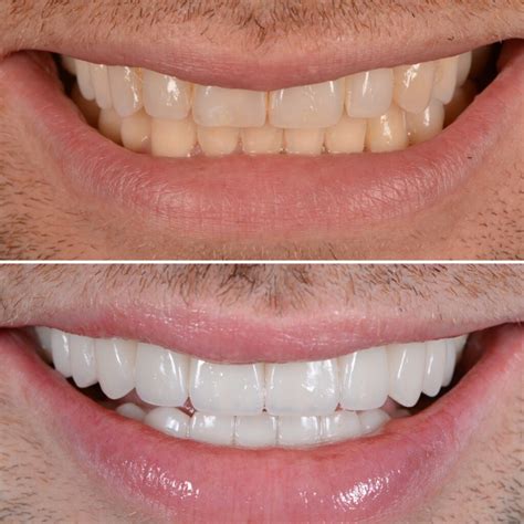 Everything You Need To Know About Emax Veneers Bespoke Smile