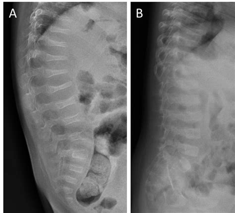 Fracturas Vertebrales Hot Sex Picture