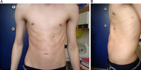 Paralysis Of The Rectus Abdominis Muscle After Video Assisted