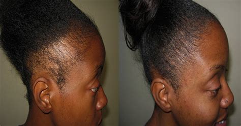 Check spelling or type a new query. African American Female Hair Transplant | Hair loss Forum ...