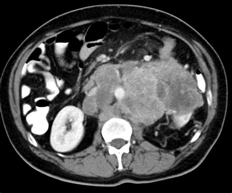 Abdominal CT Scan Lymph Nodes