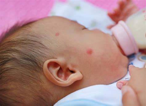 Close Up Face Of Infant Have A Mosquito Bites Premium Photo