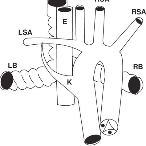 Diagram Showing Vascular Ring In Posterior View K Kommerells