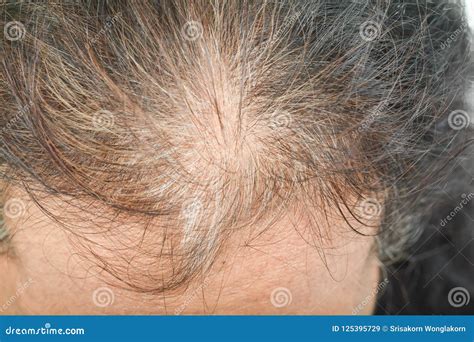Thin Hair In Women Stock Image Image Of Loss Care 125395729