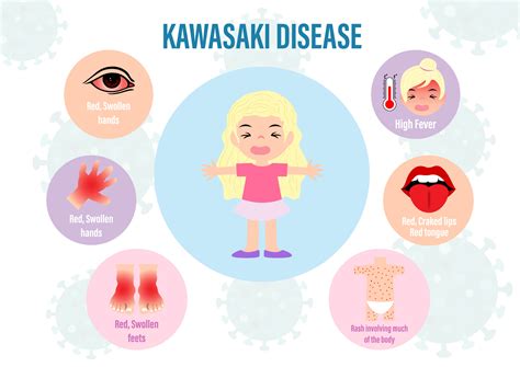 Kawasaki Disease What Is Symptoms Diagnosis And Treatment March 2024
