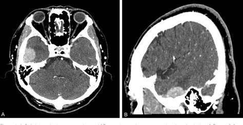 Figure 1 From Intracranial Rosai Dorfman Disease Mimicking Isolated