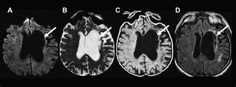 Mr Diffusion Imaging In Ischemic Stroke Radiology Key