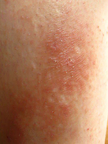 What Is Dermatitis Contour Dermatology