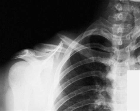 Collarbone Pain Clavicle Pain Causes And Treatment 2018 Updated