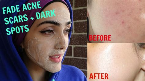 Widely Used Get Rid Of Freckles Treatment Renewal Skin