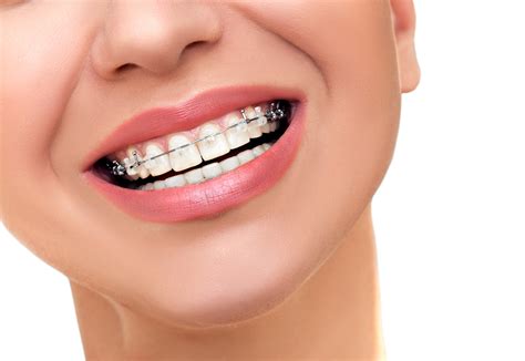 When to Consider Braces - Adults and Kids | Dental Health Group
