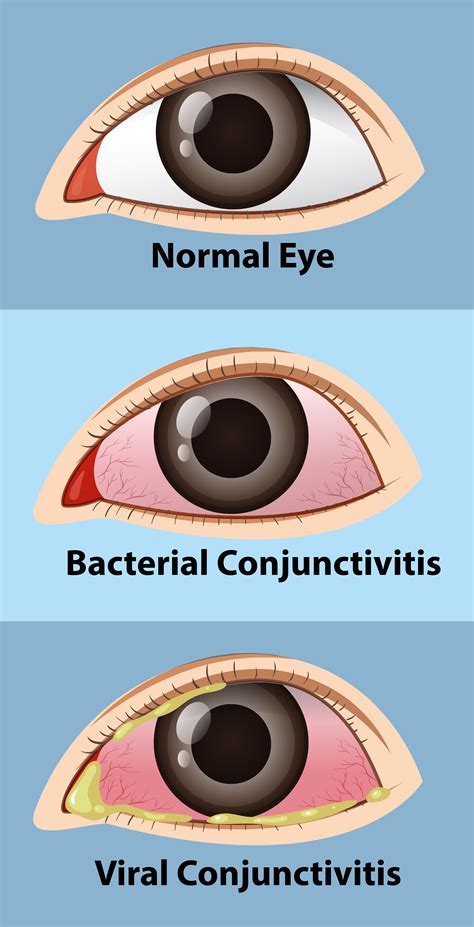 Different Stages Of Conjunctivitis In Human Eye 559731 Vector Art At
