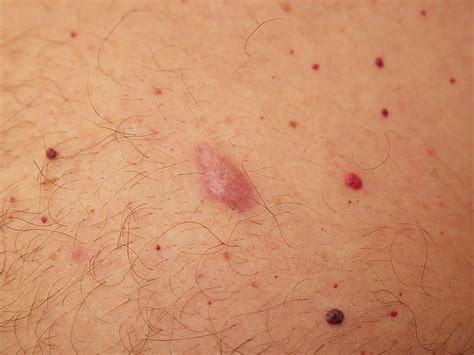Red Bumps On Skin