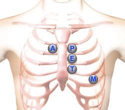 Disease of the heart valves remains an important cause of morbidity and mortality across the world. Heart Murmur auscultation location areas | Lung sounds ...