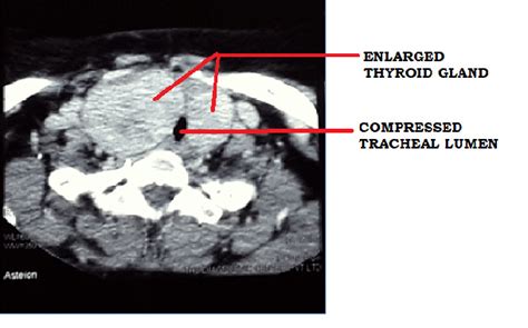 Ct Scan Showing Enlarged Thyroid Gland And Compressed Trachea