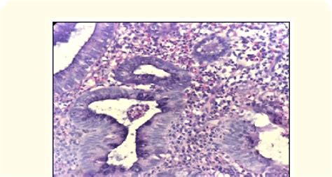 Microphotograph Of Ulcerative Colitis Of Sigmoid Biopsy With Crypt