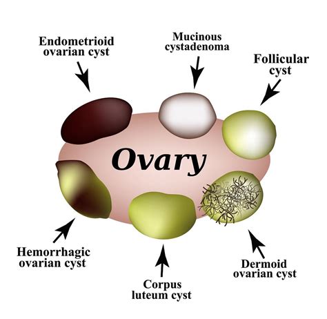 Ovarian Cysts Types Symptoms Treatment Remedies Images Credoweb