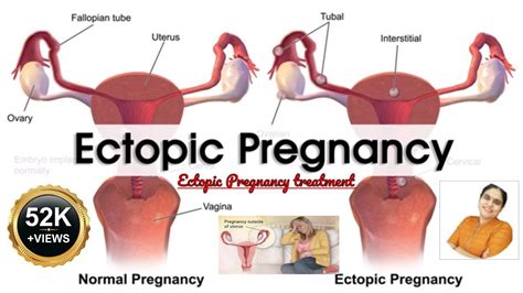 Ectopic Pregnancy Medical Treatment Avoid Surgery Laparoscopic