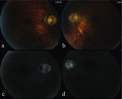 Fundus Photography Ab And Fundus Fluorescein Angiography Cd At