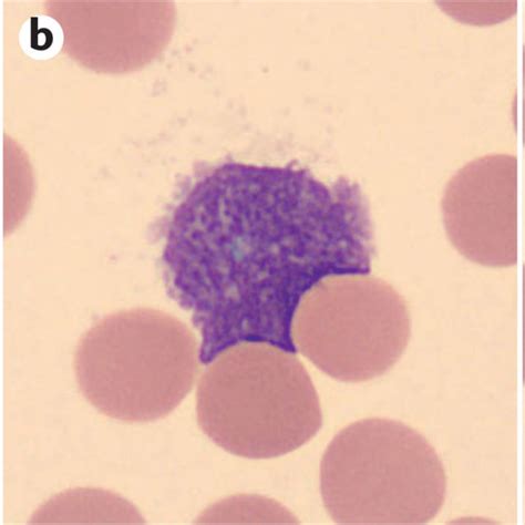 Blood Smears From Patients With Cll Wright Giemsa Stained Blood Smears