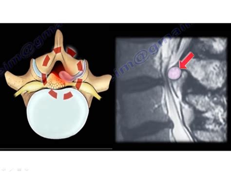 Synovial Cyst Of The Spine Orthopaedicprinciples Com