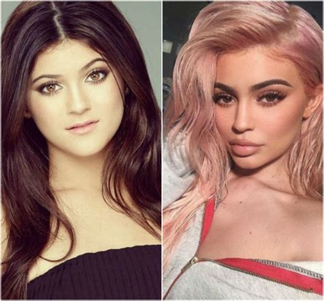 Kylie jenner before looked very inconspicuous before eye surgery and her eyes were not so hypnotized, no matter how much she tried to smooth out this matter with makeup. Kylie Jenner's Lips - Before and After Pictures of Her Pout