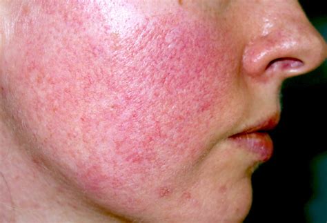 Acne Rosacea Causes And Diagnose The Natural Cure