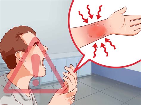 How To Stop The Burning In First Degree Burns Temporarily 9 Steps