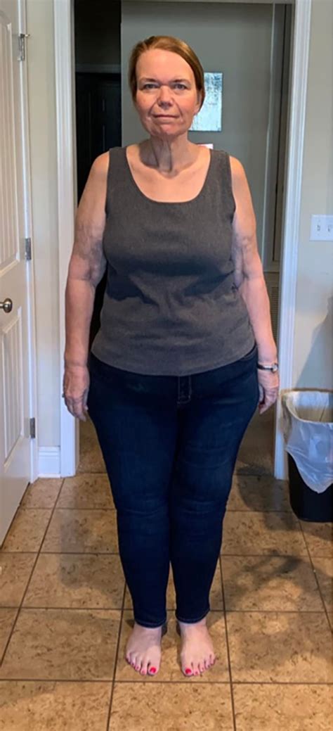 Before And After Premier Lipedema Clinic