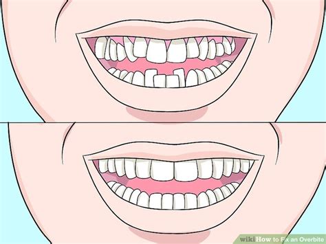 However, more severe bite issues or misalignments are better suited for more traditional treatment options, like braces. How to Fix an Overbite: 9 Steps (with Pictures) - wikiHow