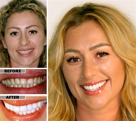 Cosmetic Dentistry In Brooklyn Ny Envy Smile Dental Spa