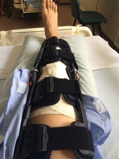 Week 1 Day 2 Post Acl Surgery Recovery Acl Surgery Blog