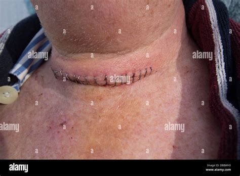 Cuello Del Hombre Mostrando La Tiroidectomía Incisión Quirúrgica Con