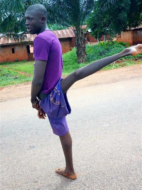 See The Young Man Whose One Leg Is Always Up Due To Rare Medical