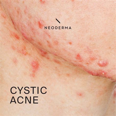 Cystic Acne Skin Types Neoderma