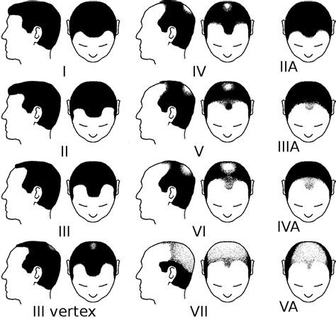 The Norwood Scale Understanding Hair Loss Stages