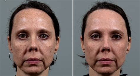 Amazing Results With One Ipl Treatment Seiler Skin