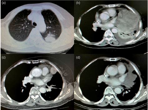 Figure 1 From Anaplastic Lymphoma Kinase Alk Rearranged Pulmonary