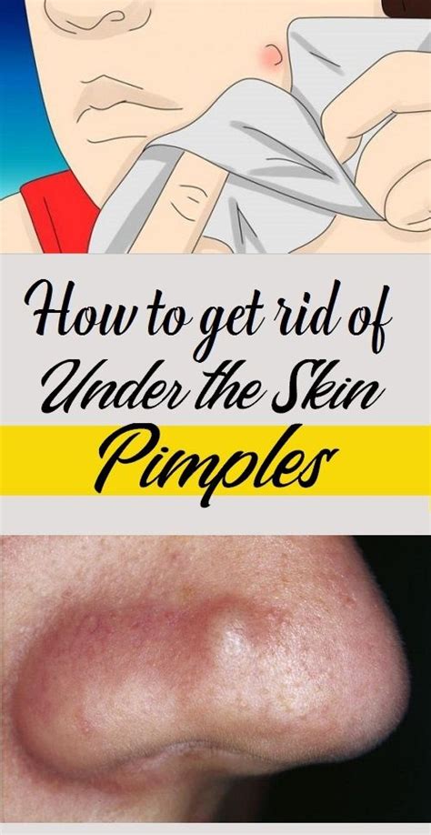 How To Get Rid Of Under The Skin Pimples Beautytips Pimplesremove