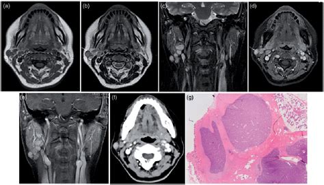 Figure 2 From Mri And Ct Imaging Characteristics Of Myoepithelioma Of