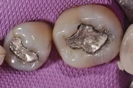 This discussion of the dental amalgam controversy outlines the debate over whether dental amalgam (the mercury alloy in dental fillings) should be used. Do amalgam dental fillings breakdown into the body over ...