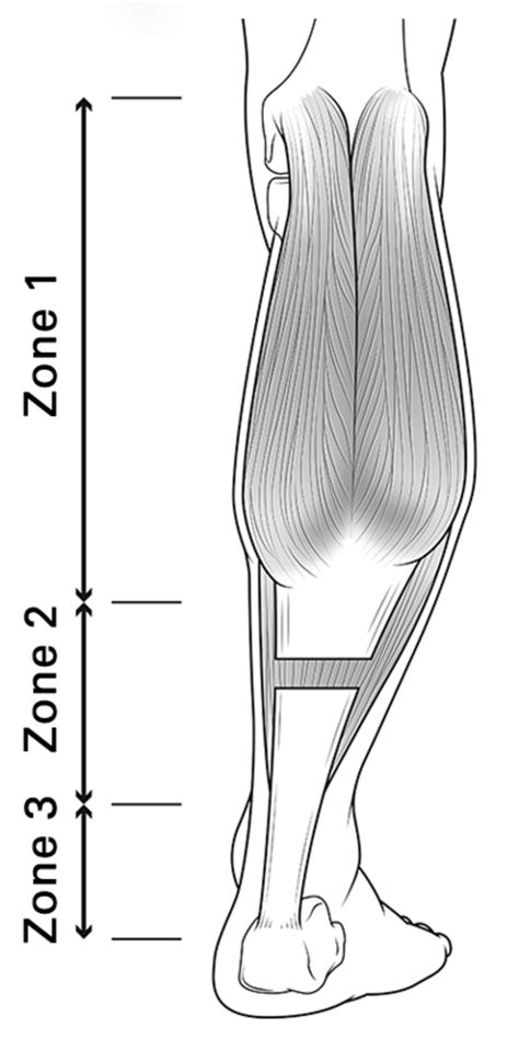 The Transverse Vulpius Gastrocsoleus Recession For Equinus Gait In